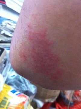 手臂上出现红斑图片